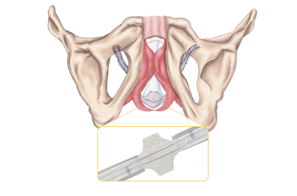 Malla ATOMS: un sistema regulable para tratar la incontinencia urinaria  masculina - Instituto de urología Serrate Ribal